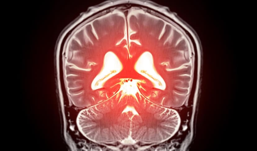 የአልዛይመር ምልክቶችን በአንድ ደቂቃ መለየት ተቻለ